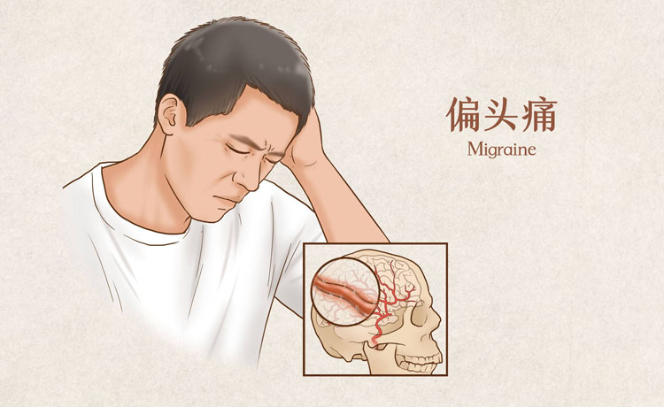 偏头痛的症状有哪些