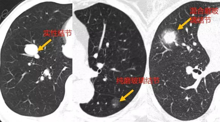 肺上长小结节是怎么回事？严重吗？