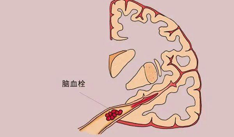 脑血栓形成的症状有哪些