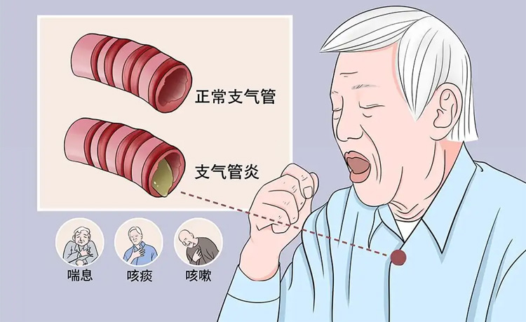 慢性支气管炎怎么治疗