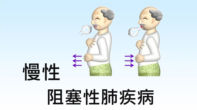 慢性阻塞性肺疾病的症状有哪些