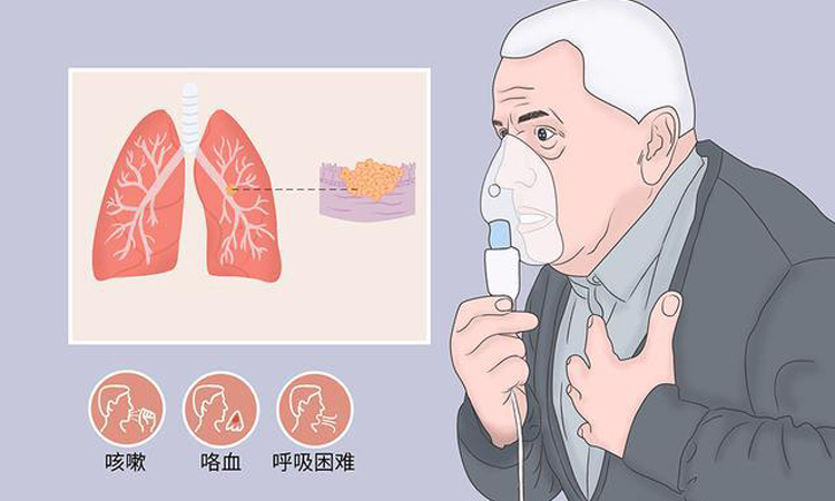 肺癌早期怎么治疗