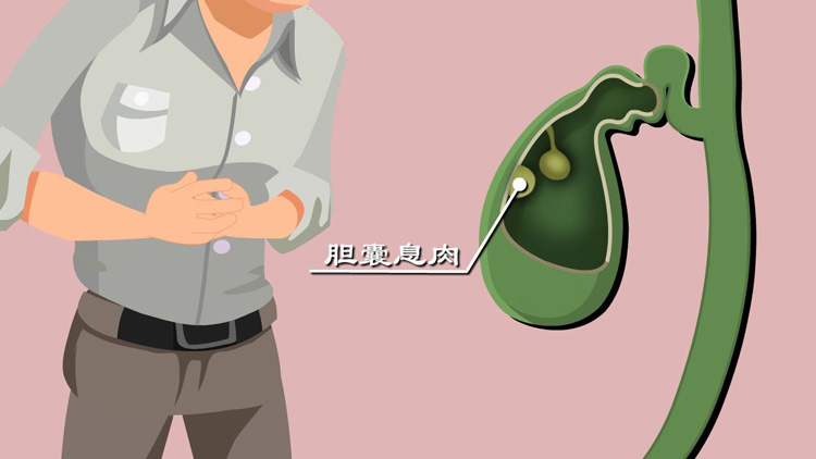 什么是胆囊息肉