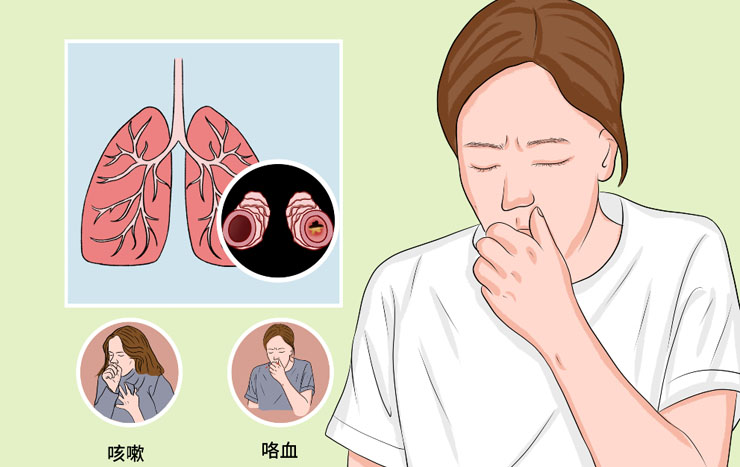 支气管扩张咯血怎么办