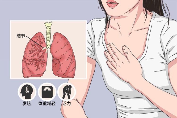 肺结节别轻易开刀