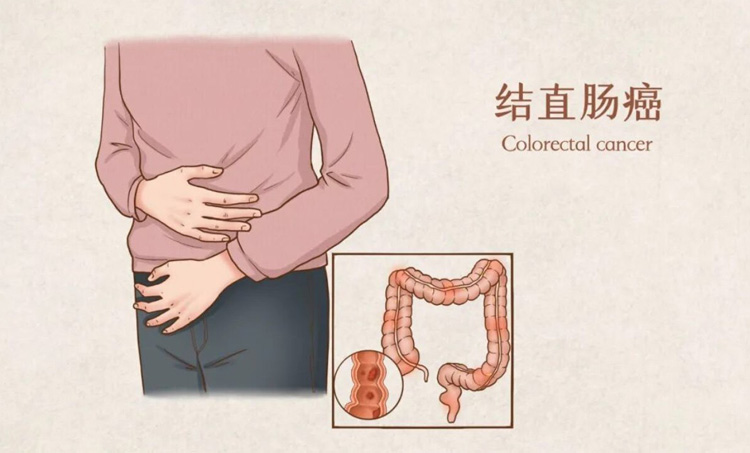 结肠癌的症状有哪些