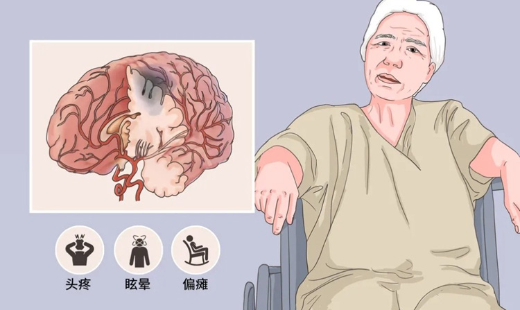 中风的症状有哪些