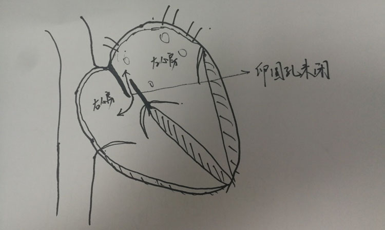 什么是卵圆孔未闭